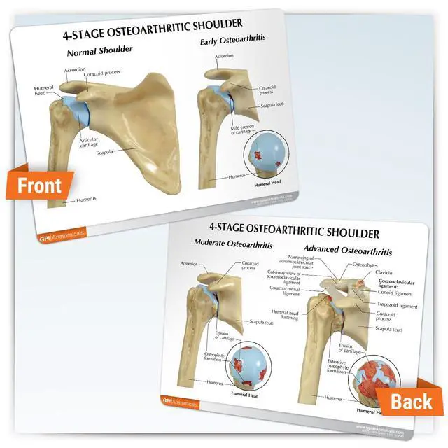 Alt view image 5 of 6 - Shoulder Osteoarthritic (OA) 4-Stage Anatomical Model | Human Body and Anatomy Replica for Physiology Education, Anatomical Model for Doctor's Office, Medical Learning Resources