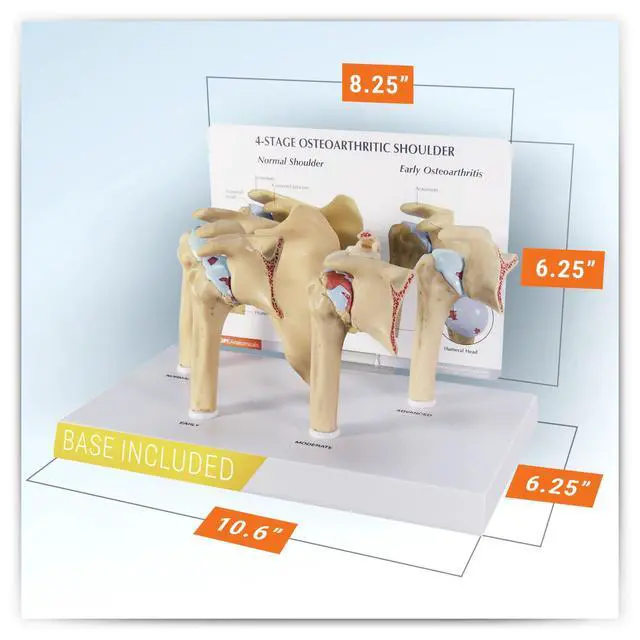 Alt view image 6 of 6 - Shoulder Osteoarthritic (OA) 4-Stage Anatomical Model | Human Body and Anatomy Replica for Physiology Education, Anatomical Model for Doctor's Office, Medical Learning Resources