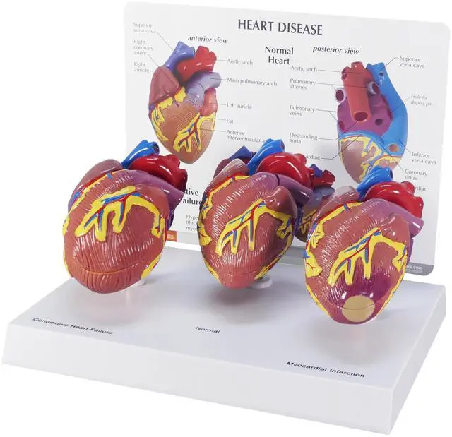 Main image of 3-Piece Mini Heart Model Set, Normal and Diseased | Human Body and Anatomy Replica for Physiology Education, Anatomical Model for Doctor's Office, Medical Learning Resources