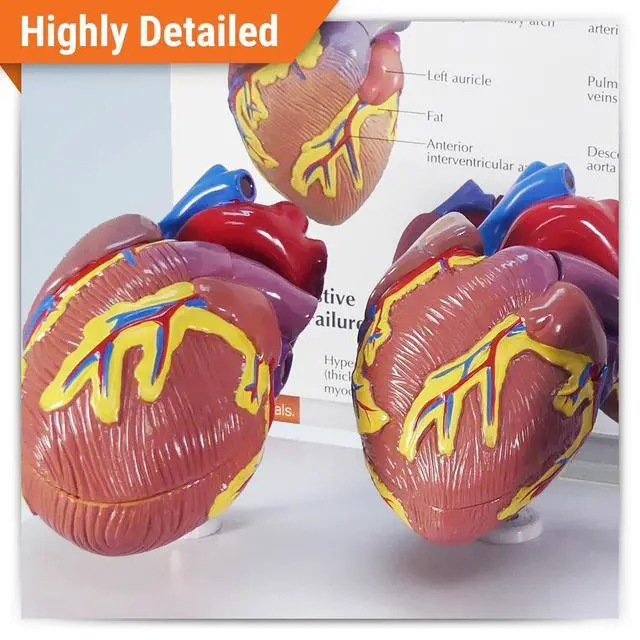 Alt view image 2 of 6 - 3-Piece Mini Heart Model Set, Normal and Diseased | Human Body and Anatomy Replica for Physiology Education, Anatomical Model for Doctor's Office, Medical Learning Resources