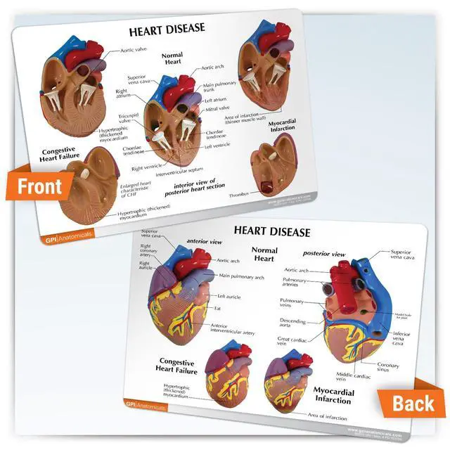 Alt view image 5 of 6 - 3-Piece Mini Heart Model Set, Normal and Diseased | Human Body and Anatomy Replica for Physiology Education, Anatomical Model for Doctor's Office, Medical Learning Resources