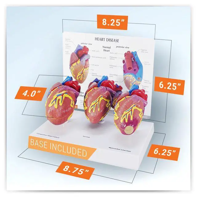 Alt view image 6 of 6 - 3-Piece Mini Heart Model Set, Normal and Diseased | Human Body and Anatomy Replica for Physiology Education, Anatomical Model for Doctor's Office, Medical Learning Resources