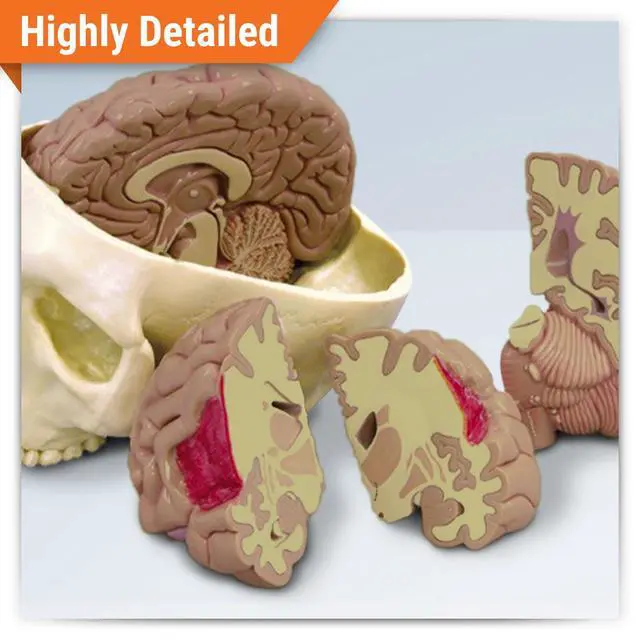 Alt view image 2 of 6 - Brain Model Inside Partial Skull Afflicted by Pathologies | Human Body and Anatomy Replica for Physiology Education, Anatomical Model for Doctor's Office, Medical Learning Resources