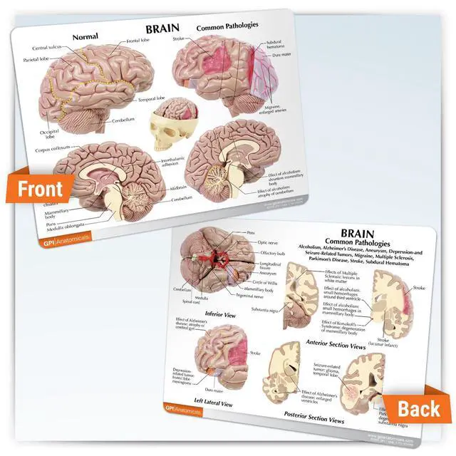 Alt view image 5 of 6 - Brain Model Inside Partial Skull Afflicted by Pathologies | Human Body and Anatomy Replica for Physiology Education, Anatomical Model for Doctor's Office, Medical Learning Resources