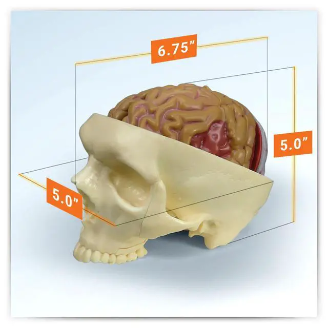 Alt view image 6 of 6 - Brain Model Inside Partial Skull Afflicted by Pathologies | Human Body and Anatomy Replica for Physiology Education, Anatomical Model for Doctor's Office, Medical Learning Resources