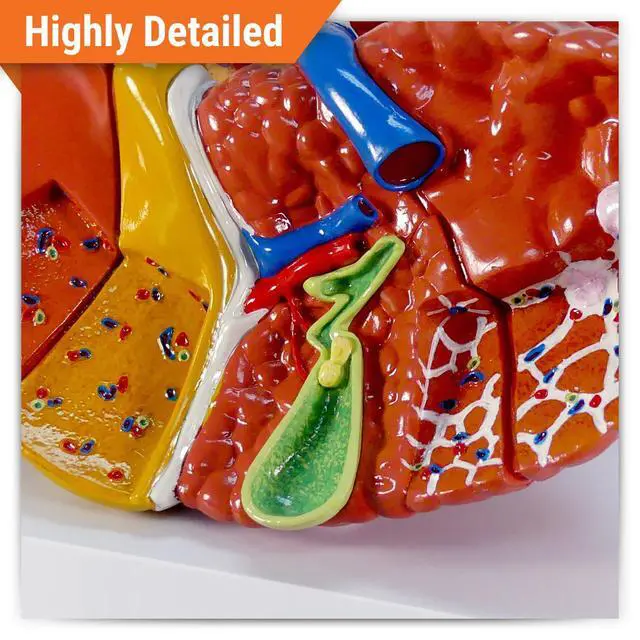 Alt view image 2 of 6 - Liver Model with Common Pathologies | Human Body and Anatomy Replica for Physiology Education, Anatomical Model for Doctor's Office, Medical Learning Resources