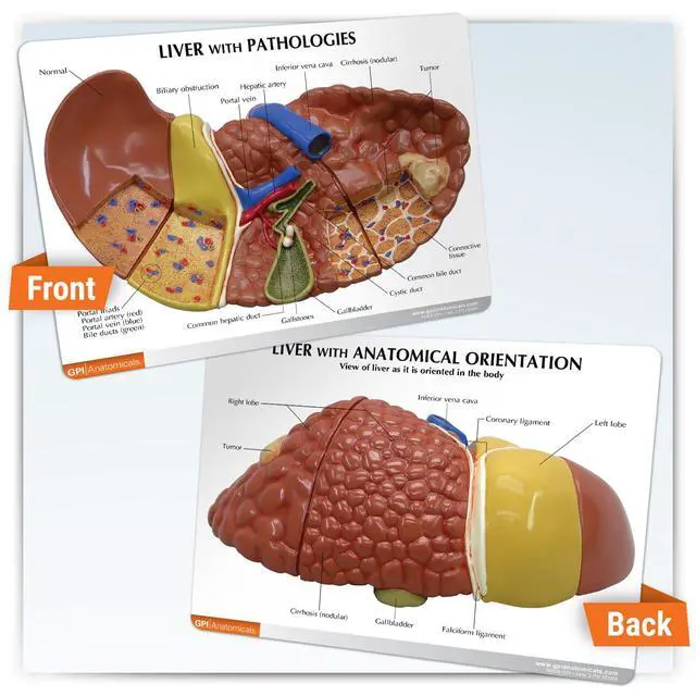 Alt view image 5 of 6 - Liver Model with Common Pathologies | Human Body and Anatomy Replica for Physiology Education, Anatomical Model for Doctor's Office, Medical Learning Resources