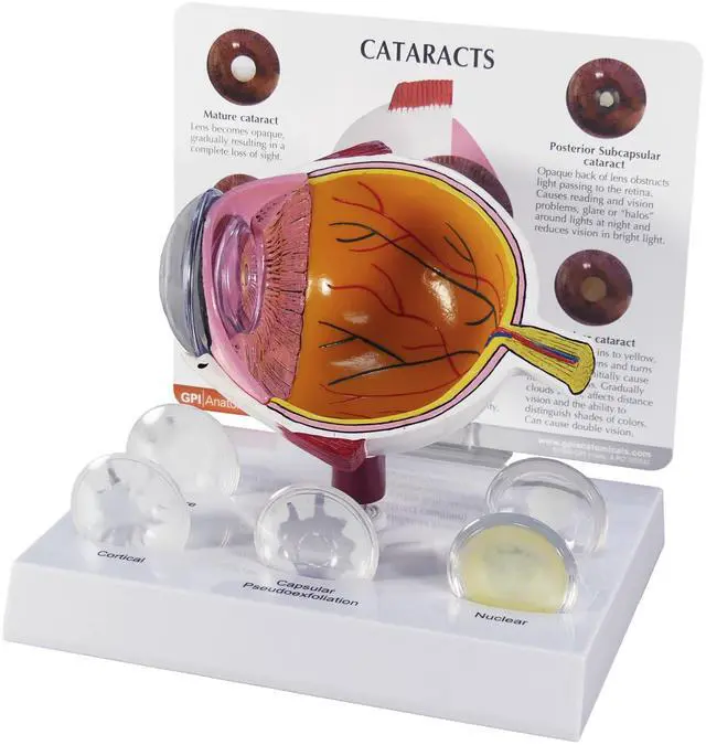 Main image of Cataract Eye Model of an Eye with Cataract Conditions | Human Body and Anatomy Replica for Physiology Education, Anatomical Model for Doctor's Office, Medical Learning Resources