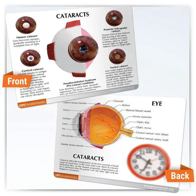Alt view image 5 of 6 - Cataract Eye Model of an Eye with Cataract Conditions | Human Body and Anatomy Replica for Physiology Education, Anatomical Model for Doctor's Office, Medical Learning Resources