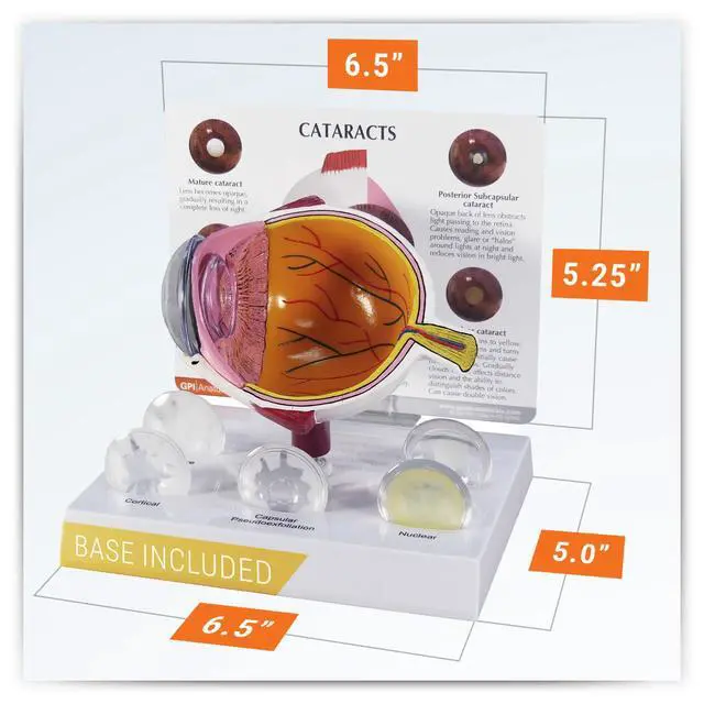 Alt view image 6 of 6 - Cataract Eye Model of an Eye with Cataract Conditions | Human Body and Anatomy Replica for Physiology Education, Anatomical Model for Doctor's Office, Medical Learning Resources