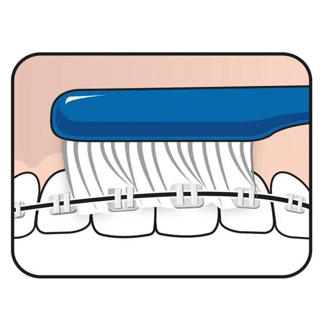 Alt view image 4 of 4 - Implant Orthodontic Soft Toothbrush ñ Extra Narrow Brush Head Thin Neck 1Pk