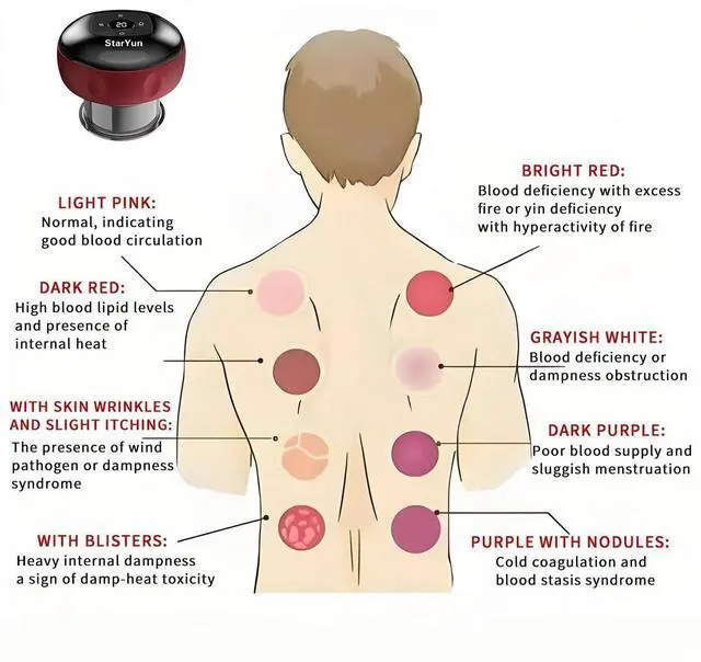 Alt view image 3 of 7 - Electric Cupping Set 2-Pack, Dual Vacuum Suction Body Massagers with Red Light & Heat Therapy, 60kPa Stronger Suction, 12 Levels, for Neck Shoulder Back Muscle Pain Relief (Black 2 Pack)