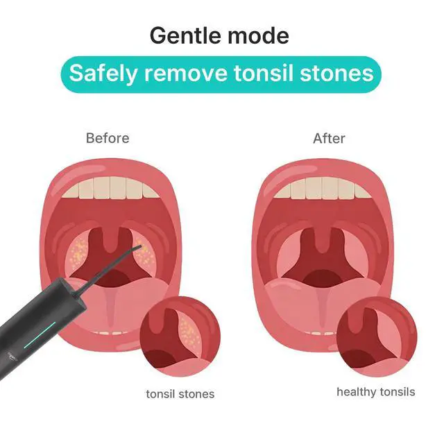 Alt view image 2 of 7 - Water Flosser Safe Tonsil Stone Remover Prevent Bad Breath, Black
