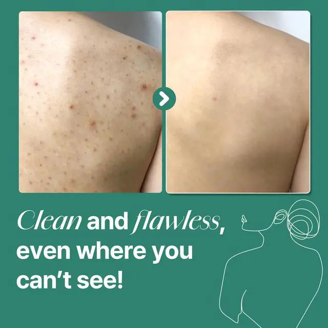 Alt view image 5 of 7 - AHA BHA PHA 30 Days Miracle Acne Clear Body Cleanser 13.5oz Salicylic Acid & Tea Tree Acne Body Wash Deep Cleansing, Sulfate & Paraben Free Korean Skin care