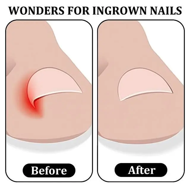 Alt view image 5 of 7 - Ingrown Toenail Clippers, Straight Blade Toe Nail Clippers for Thick Toenails, Stainless Steel Fingernail Toenail Clipper for Seniors, Men and Adult