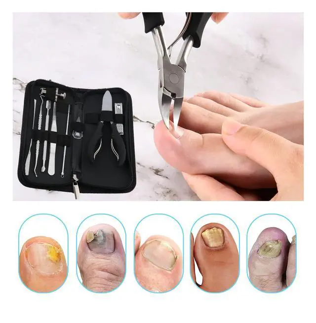 Alt view image 3 of 7 - 10Pcs/set Ingrown Toenail Tools Kit, Nail Treatment Foot Tool,Ingrown Toenail Removal Correction Clippers, Surgery Grade Nail File Lifter, Professional Pedicure Tool