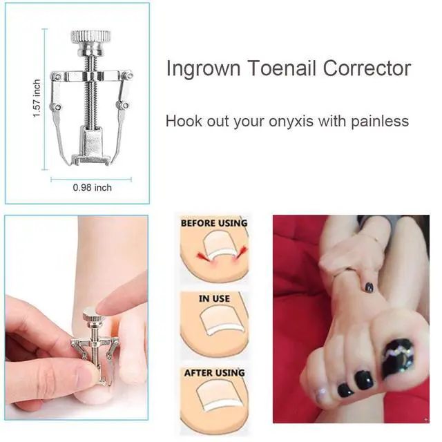 Alt view image 6 of 7 - 10Pcs/set Ingrown Toenail Tools Kit, Nail Treatment Foot Tool,Ingrown Toenail Removal Correction Clippers, Surgery Grade Nail File Lifter, Professional Pedicure Tool
