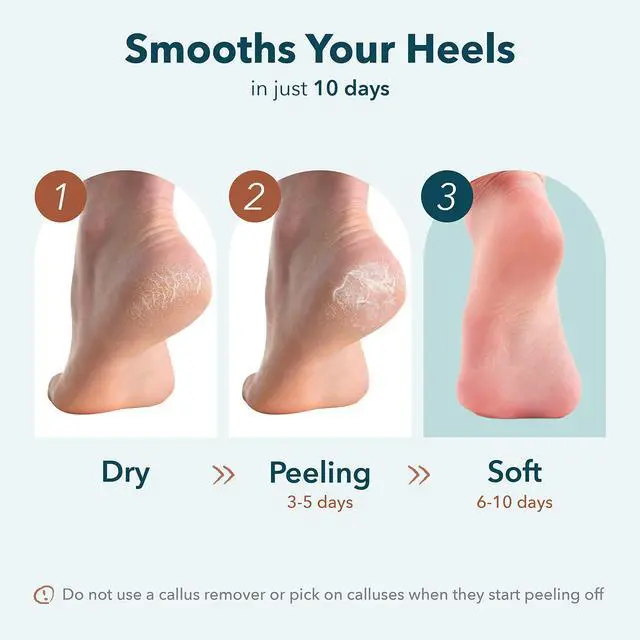 Alt view image 3 of 7 - Exfoliating Foot Peeling Mask & Foot Peel for Dry Cracked Heels (1 Pack) Dead Skin & Callus Remover for Feet, Rough Skin Care for Baby Soft Feet