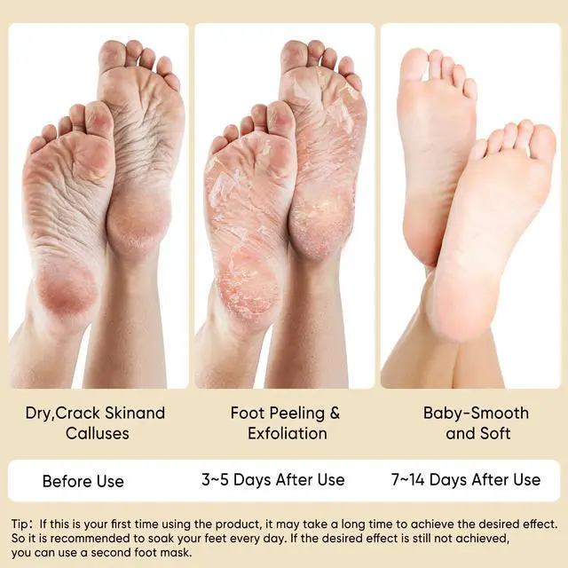 Alt view image 5 of 7 - Coconut Foot Peeling Mask, 3 Pairs of Skin Exfoliating Foot Masks for Dry feet, Cracked heels, Callus, Dead Skin Remover,for Smooth Touch Feet, Spa Experience at Home or Travel