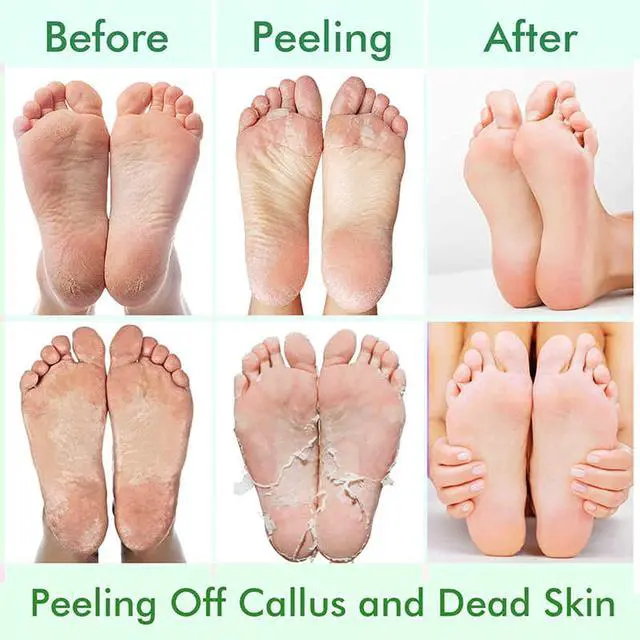 Alt view image 3 of 7 - 5 Pack Foot Peeling Mask,Exfoliator Peel Off Calluses Dead Skin Callus Remover,Foot Mask for Dry Cracked Feet,Foot Peel Masks for Men and Women,Feet Peeling Mask,Spa Gifts for Women,Self Care Gifts