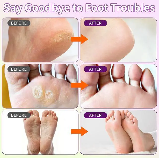 Alt view image 2 of 7 - 6 Pack Foot Peeling Mask, Foot Mask for Exfoliates Dead Skin & Tough Calluses, Softens Dry Cracked Rough Heels to Restore Baby Soft Feet, Feet Peeling Mask Gift for Men Women, Birthday & Anniversary