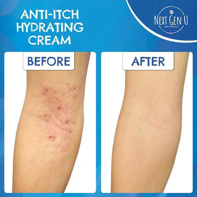 Alt view image 5 of 7 - Calming Relief Cream - 8.5 oz / 250 ml - Moisturizing Comfort from Itchy Skin, Helps Alleviate Itch from Eczema, Hives, Sunburn - Vegan Formula with Shea Butter & Tea Tree Oil
