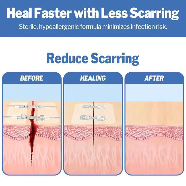 Alt view image 7 of 7 - 16 Pack Wound Closure Strips, 4 Types Butterfly Bandages, Emergency Laceration Closure Kit, Repair Wounds Without Stitches, Quick Clot Zip Stitch Wound Closures Device
