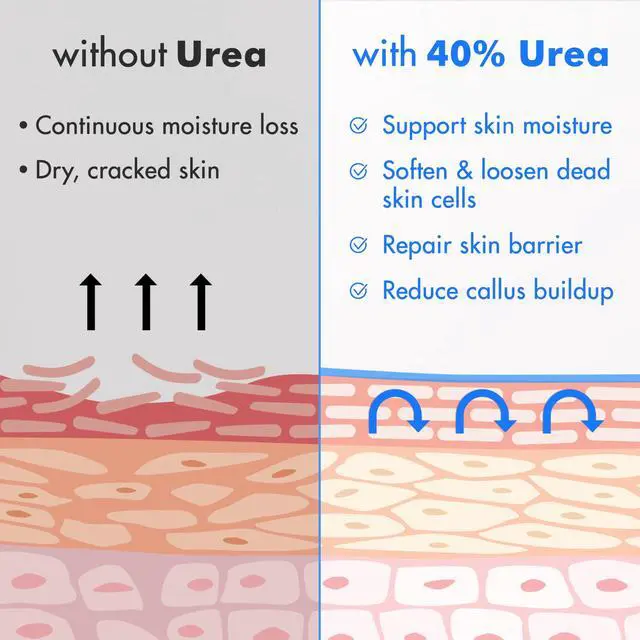Alt view image 5 of 7 - Urea Cream 40% plus Salicylic Acid 2% for Dry Cracked Feet Skin