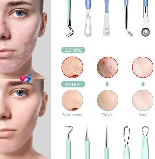 Alt view image 3 of 7 - Blackhead Remover Tools 10Pcs Pimple Popper Tool Kit, Blackhead Remover Extractor Tools, Anti-Slip Handle Pimple Comedone Extractor Acne Kit for Blackhead,Blemish,Zit Whitehead