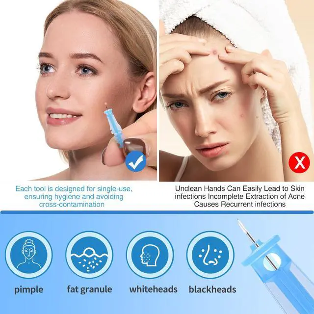 Alt view image 3 of 6 - Sterile Pimple Needle Kit - 80 pcs 0.3mm Ultra-Fine Acne Needles + 108 Dots Acne Pimple Stickers - Effective Blemish & Blackhead Removal Tools for Clear Skin