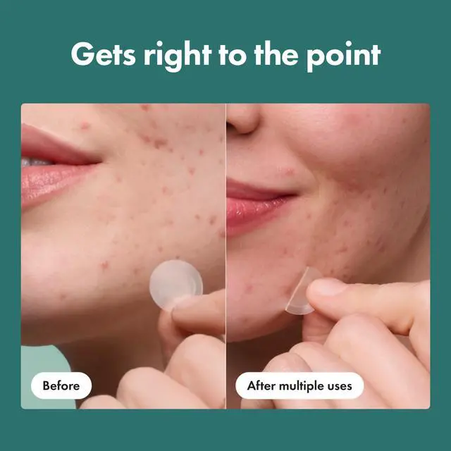 Alt view image 6 of 7 - Hero Cosmetics Micropoint Acne Pimple Patches, 8 Ct