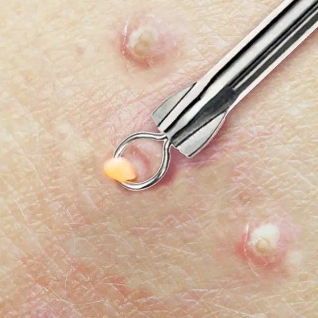 Alt view image 4 of 5 - Needle Blackhead Remover Pimple Extractor Popper for Acne Comedone Blemish Whitehead Zit Removal Tool