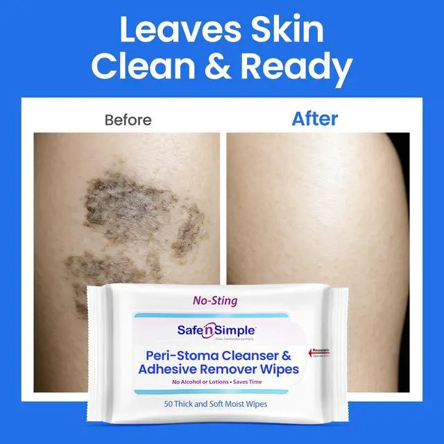 Alt view image 7 of 7 - Resealable Adhesive Remover Wipes for Skin - 50 Large 5"x7" No Sting Alcohol Free Medical Adhesive Remover Pads for Ostomy, Stoma Care - Gentle Adhesive Removal Wipes for Bandages, Tape