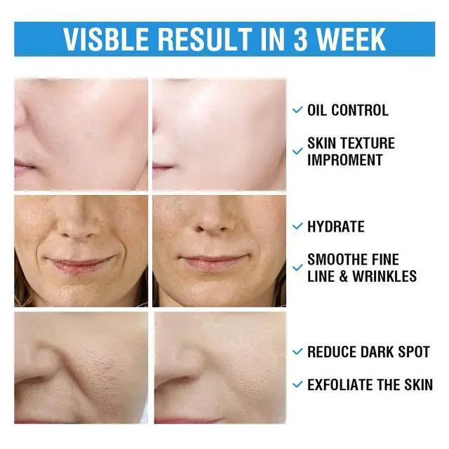 Alt view image 6 of 6 - 10% Glycolic Acid + 2% Salicylic Acid Peel Pads - BACHERI Resurfacing Pads For Face with Vitamins B5, C & E, Allantoin - Exfoliating Facial Peel for Dark Spots, Blackhead, Acne, 55 Pcs