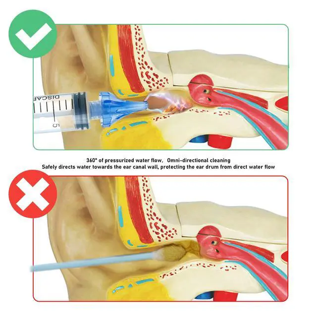 Alt view image 2 of 7 - 20mL Ear Syringes for Removing Ear Wax, Cleaning Water Irrigation Kits with 3 Penta-Stream Tips and 3 Tri-Stream Tips Improved Hearing Clarity and Aural Hygiene (clear)