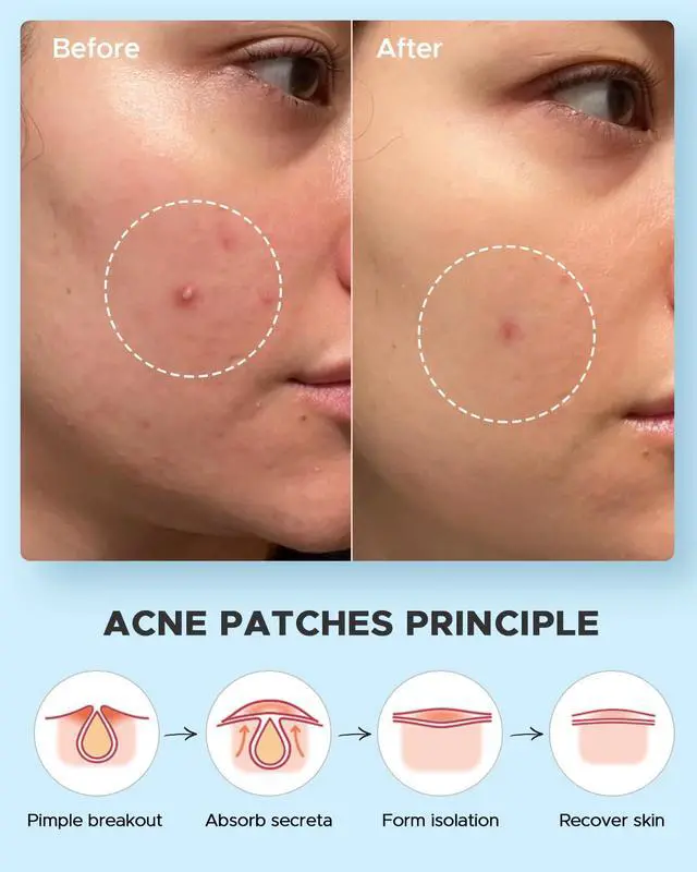 Alt view image 6 of 7 - LitBear Acne Pimple Patches- Day and Night 4 Sizes 180 Dots Thin & Thick Hydrocolloid Patches with Witch Hazel, Tea Tree & Calendula Oil, Pimple Stickers for Covering Zits, Spots, Acne Dots