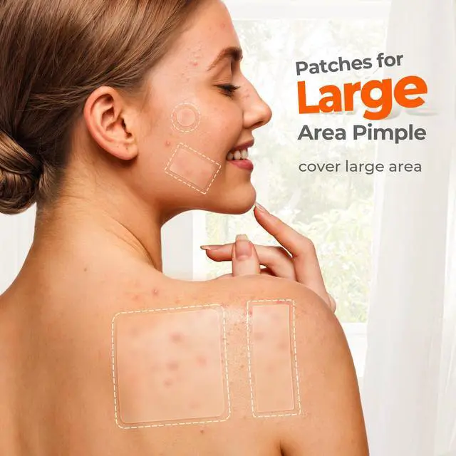 Alt view image 3 of 7 - TKTK Large Pimple Patches for Face & Body Zit Breakouts, 7 Sizes 126 Count | XL Acne Patch, for Chin, Forehead, Chest, Back, Big Hydrocolloid Bandages, Square / Strip / Dot Shapes, for All Skin Types