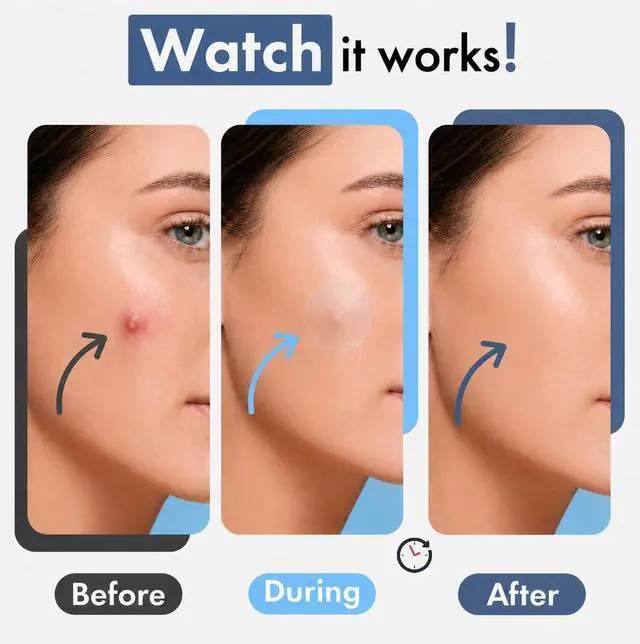 Alt view image 3 of 7 - Hellados 450 Pimple Patches For Face, 4 Size Acne Patches, Hydrocolloid Zit Patches, Blemish Patches, Spot Stickers with Tea Tree Oil and Calendula Oil