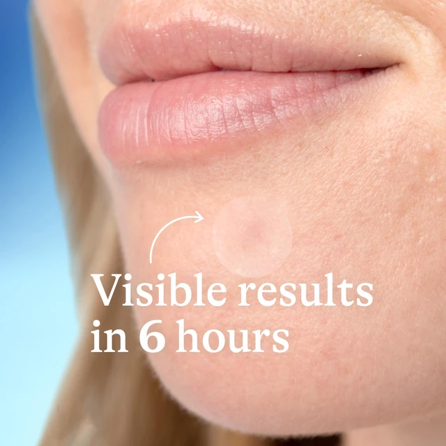 Alt view image 4 of 7 - Differin Acne Treatment Pimple Patches, Salicylic Acid & Centella, 36ct | Hydrocolloid Acne Spot Treatment, Salicylic Acid + Centella, Day & Night, Fast-Acting, Dermatologist Tested, Acne-Prone Skin