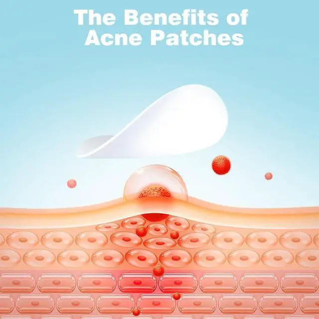 Alt view image 3 of 6 - ANNISHER 5 Size Acne Spot Dots Acne Pimple Patches for Covering Zits Blemishes Ultra Thin Spot Stickers for Face 10Pcs(450 Patches)