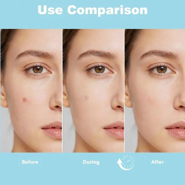 Alt view image 4 of 6 - ANNISHER 5 Size Acne Spot Dots Acne Pimple Patches for Covering Zits Blemishes Ultra Thin Spot Stickers for Face 10Pcs(450 Patches)