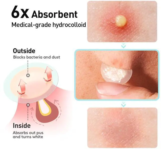Alt view image 3 of 7 - Pimple Patches, 12mm Invisible Acne Cover for Face with Salicylic Acid | 0.01cm Extra Thin Outer Edge for Daytime Wear, Hydrocolloid Zit Patch, for Blemish Pustule Whitehead Spot Coverage, 48 Count