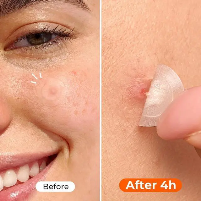 Alt view image 7 of 7 - Pimple Patches, 12mm Invisible Acne Cover for Face with Salicylic Acid | 0.01cm Extra Thin Outer Edge for Daytime Wear, Hydrocolloid Zit Patch, for Blemish Pustule Whitehead Spot Coverage, 48 Count