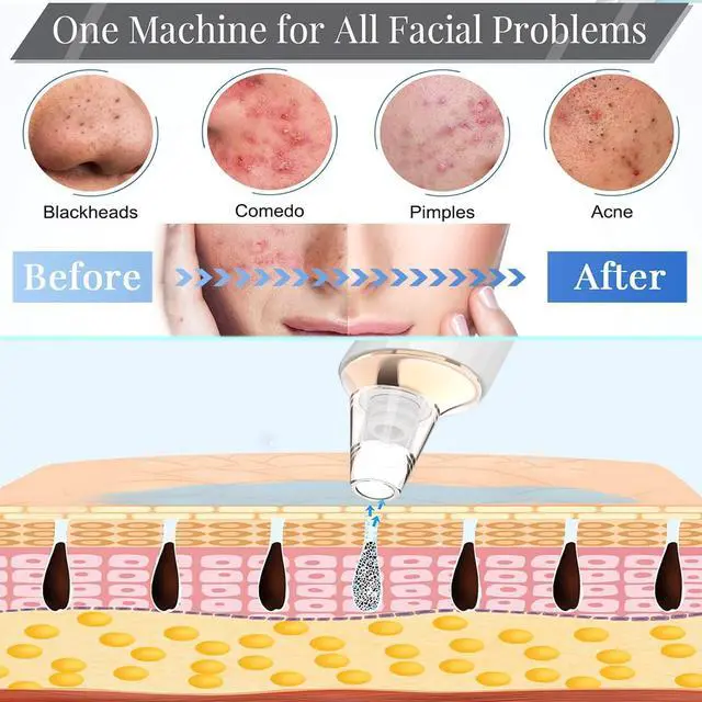 Alt view image 6 of 7 - Blackhead Remover Pore Vacuum, Upgraded USB Rechargeable Facial Pore Cleaner Blackhead Removal Kit with 3 Suction Power,5 Probes Black Head Extractions Tool for Women & Men (Snowy)