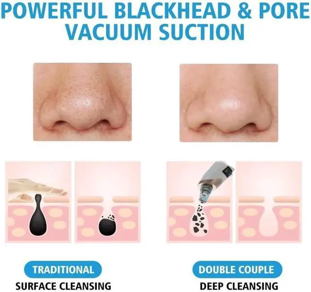 Alt view image 5 of 7 - Blackhead Remover Vacuum - Professional Blackhead Extractor for Face with 3 Adjustable Suction Levels, USB Rechargeable Pore Cleaner, and 5 Interchangeable Probes (Off-White)