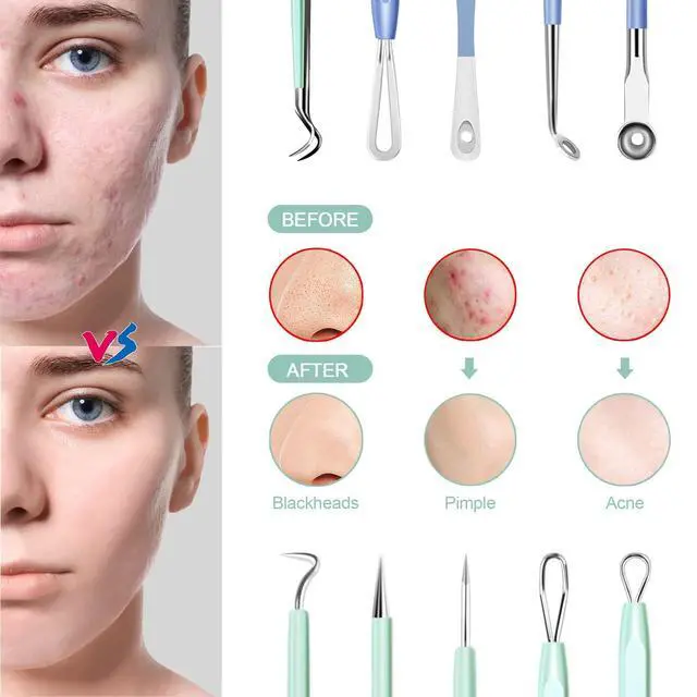 Alt view image 3 of 7 - Blackhead Remover Tools 10Pcs Pimple Popper Tool Kit, Blackhead Remover Extractor Tools, Anti-Slip Handle Pimple Comedone Extractor Acne Kit for Blackhead,Blemish,Zit Whitehead