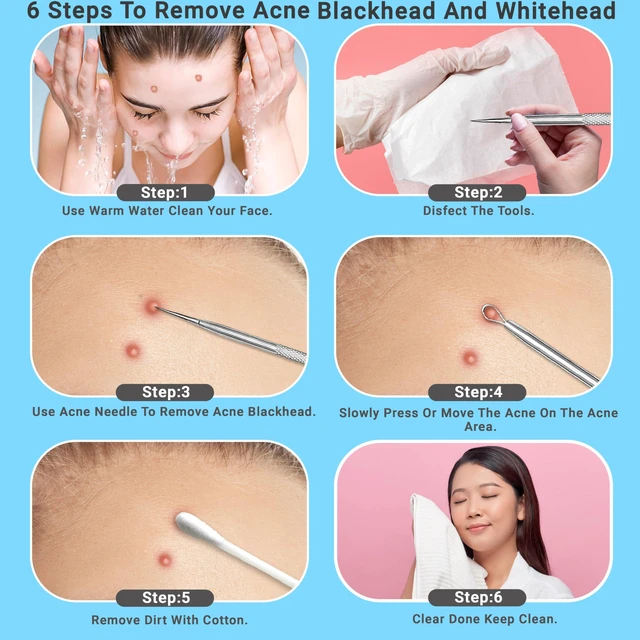 Alt view image 5 of 7 - 2Pcs Stainless Steel Pimple Extractor Acne Tool Surgical Blackhead Remover
