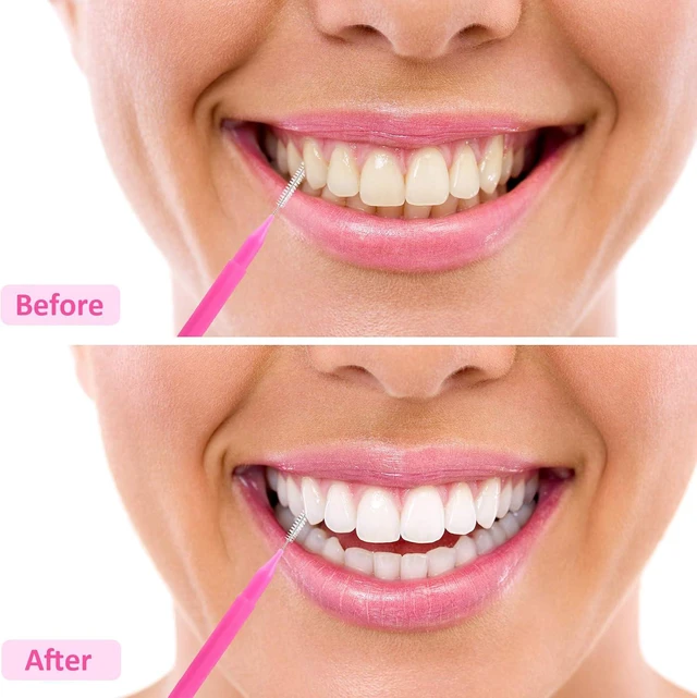 Alt view image 7 of 7 - Patelai 100 Pcs Braces Dental Brushes,Bright Colors,Multiple Sizes
