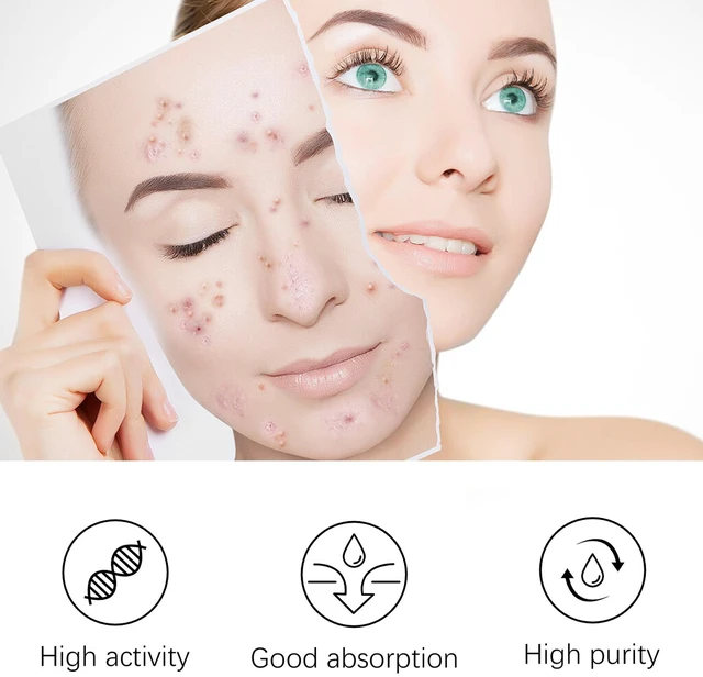 Alt view image 3 of 6 - Tea Tree Acne Essence Gentle Facial Pore Cleansing Skin Care Serum