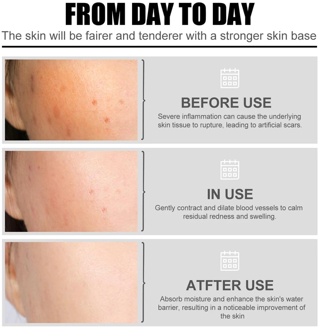 Alt view image 4 of 6 - and Skin Brightening, Pore Minimization, Moisturizing, Hydration, Niacinamide Facial Serum for Acne Scar Removal